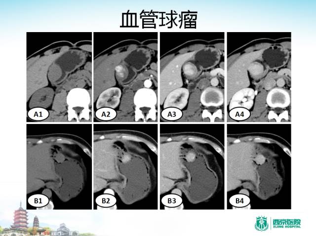 【PPT】胃部少见原发肿瘤的CT诊断