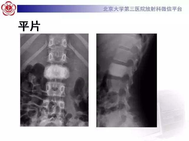【病例】腰椎尤文肉瘤1例X线CT及MR