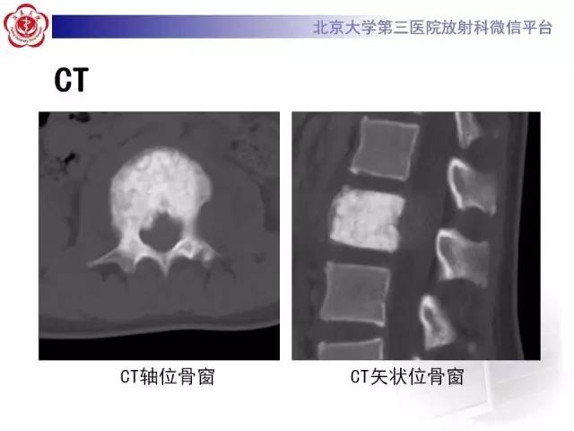 【病例】腰椎尤文肉瘤1例X线CT及MR