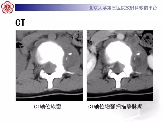 【病例】腰椎尤文肉瘤1例X线CT及MR
