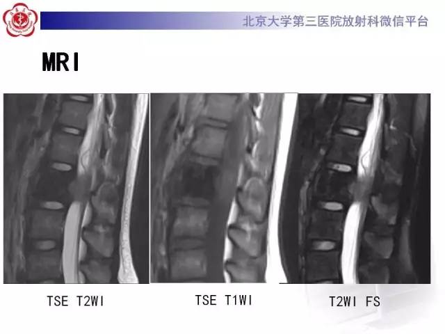 【病例】腰椎尤文肉瘤1例X线CT及MR