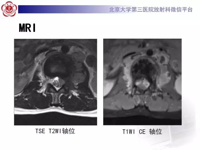 【病例】腰椎尤文肉瘤1例X线CT及MR