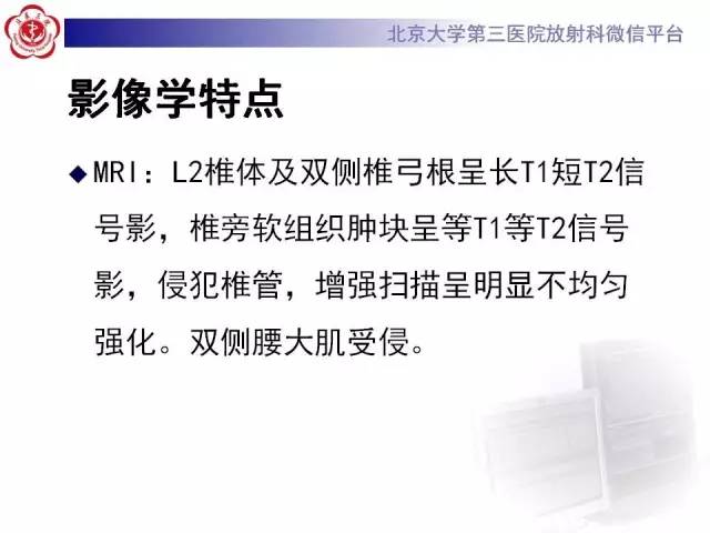 【病例】腰椎尤文肉瘤1例X线CT及MR