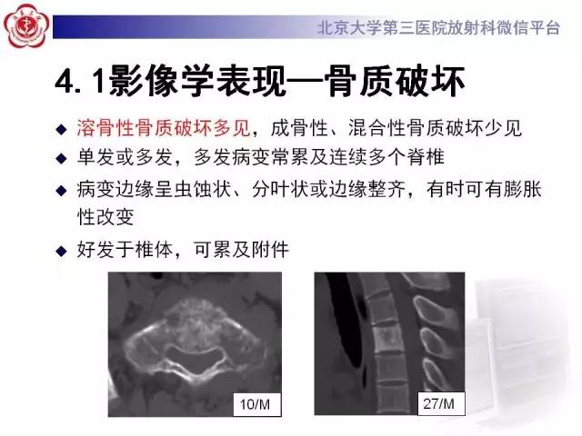 【病例】腰椎尤文肉瘤1例X线CT及MR