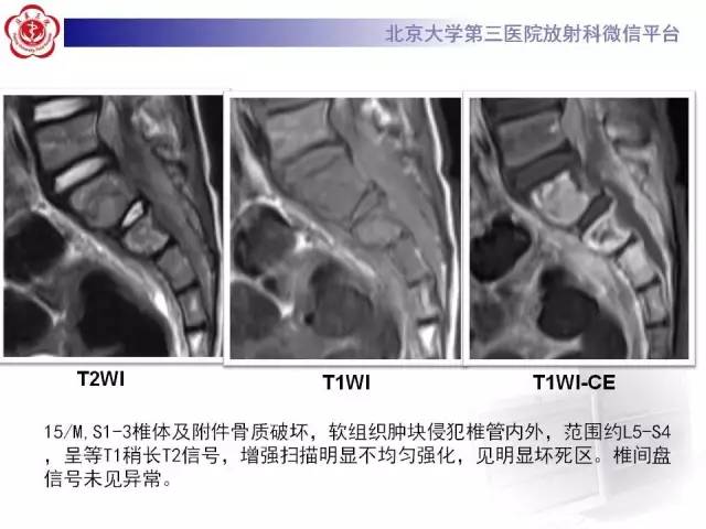 【病例】腰椎尤文肉瘤1例X线CT及MR