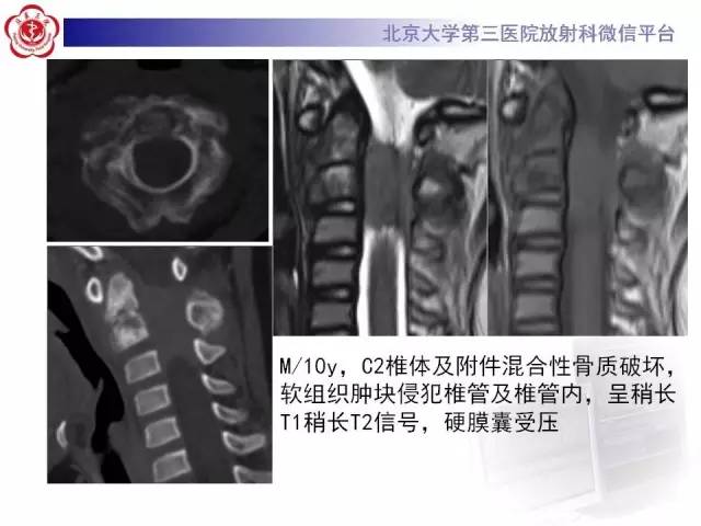 【病例】腰椎尤文肉瘤1例X线CT及MR