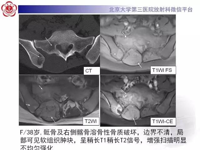 【病例】腰椎尤文肉瘤1例X线CT及MR