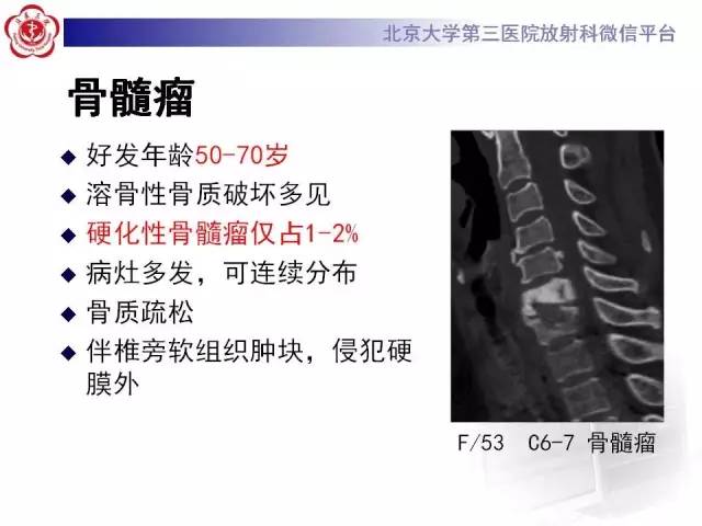 【病例】腰椎尤文肉瘤1例X线CT及MR