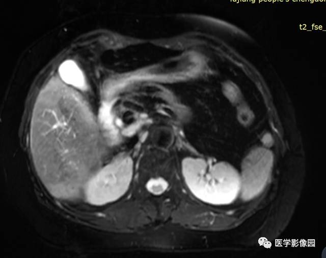 【病例】胰腺脂肪瘤1例MR影像表现