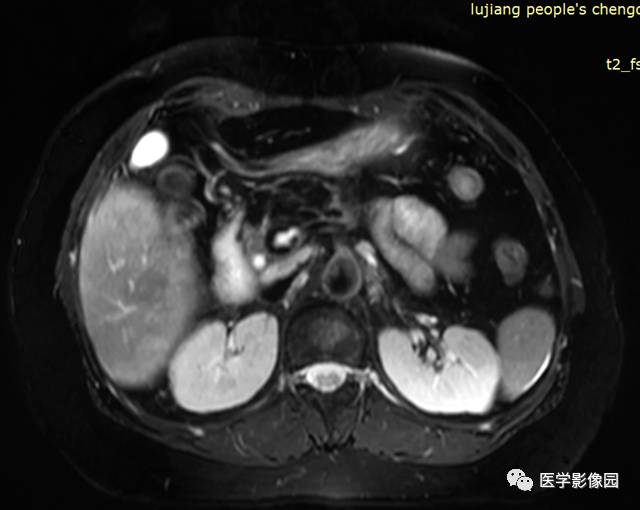 【病例】胰腺脂肪瘤1例MR影像表现