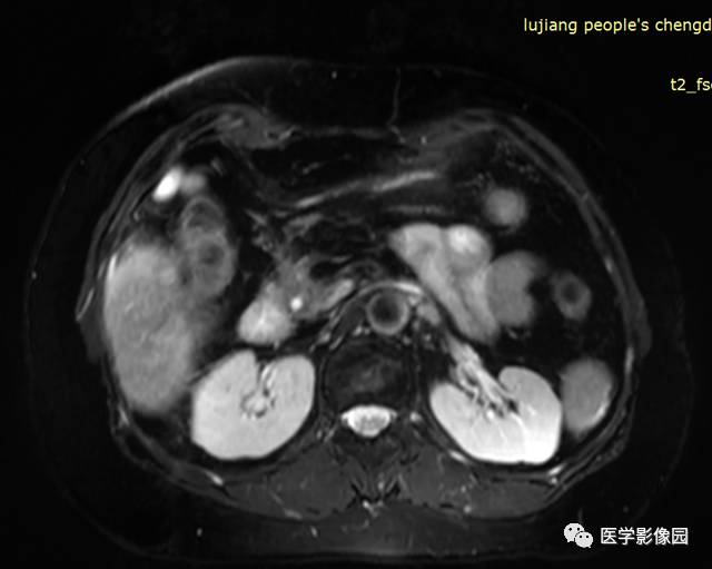 【病例】胰腺脂肪瘤1例MR影像表现
