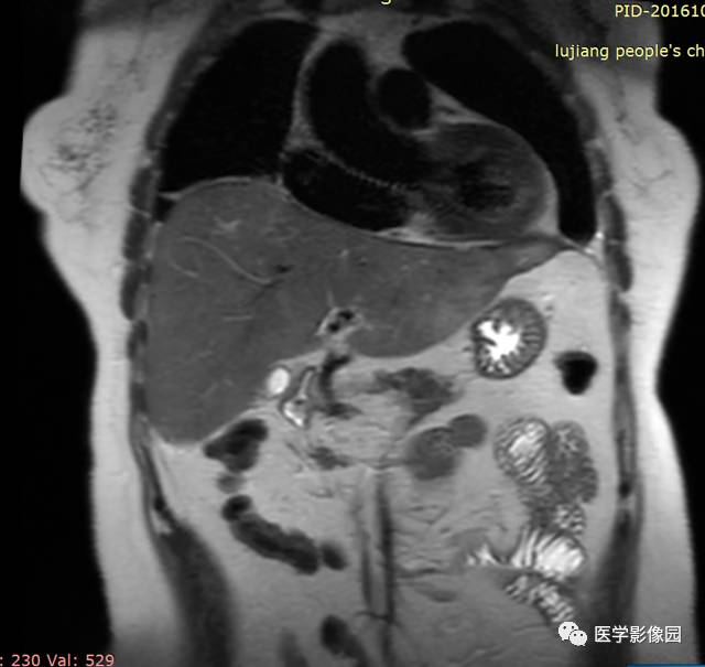 【病例】胰腺脂肪瘤1例MR影像表现