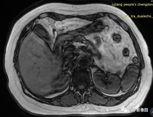 【病例】胰腺脂肪瘤1例MR影像表现