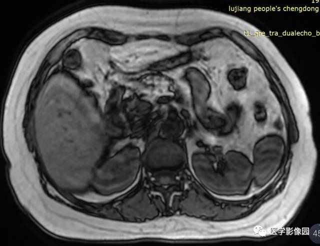 【病例】胰腺脂肪瘤1例MR影像表现