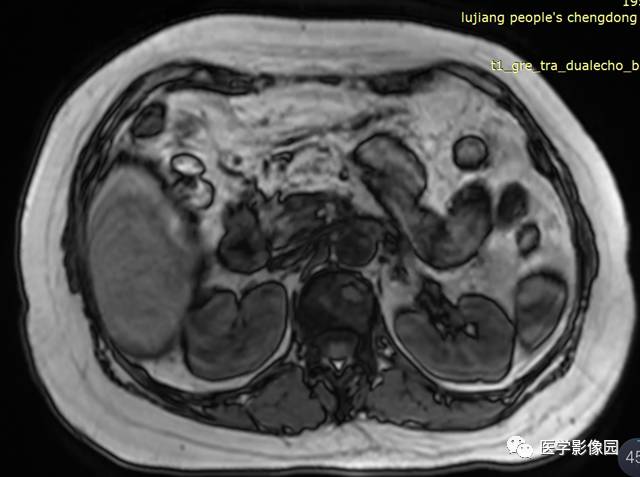 【病例】胰腺脂肪瘤1例MR影像表现