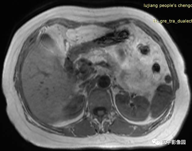 【病例】胰腺脂肪瘤1例MR影像表现