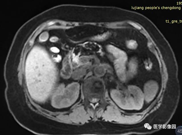 【病例】胰腺脂肪瘤1例MR影像表现
