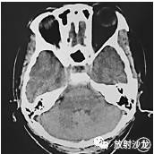 【病例】椎-基底动脉开窗畸形合并动脉瘤血管内栓塞术后并发脊髓梗死1例 【病例】椎-基底动脉开窗畸形合并动脉瘤血管内栓塞术后并发脊髓梗死1例