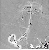 【病例】椎-基底动脉开窗畸形合并动脉瘤血管内栓塞术后并发脊髓梗死1例 【病例】椎-基底动脉开窗畸形合并动脉瘤血管内栓塞术后并发脊髓梗死1例