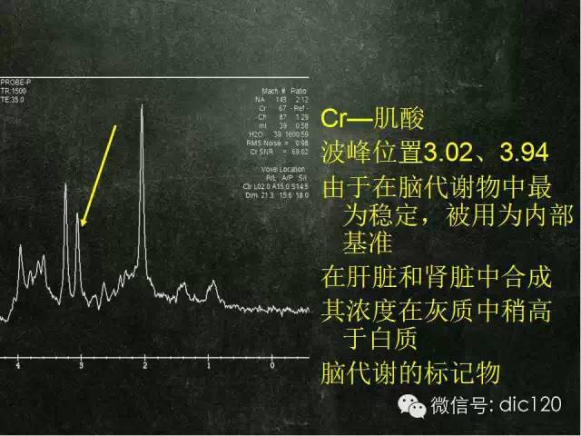 【PPT】脑磁共振波谱MRS