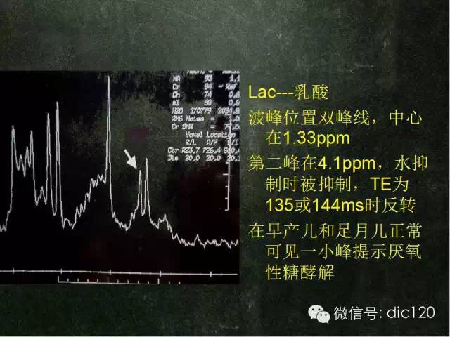 【PPT】脑磁共振波谱MRS