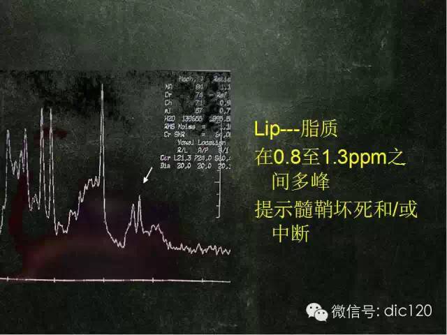 【PPT】脑磁共振波谱MRS