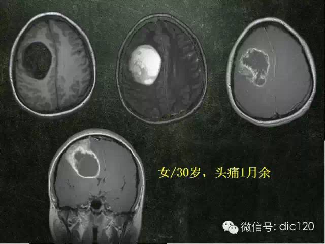 【PPT】脑磁共振波谱MRS