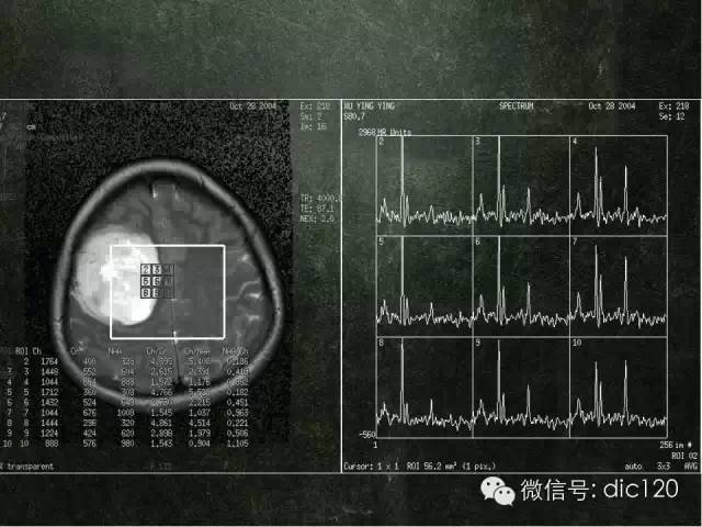 【PPT】脑磁共振波谱MRS