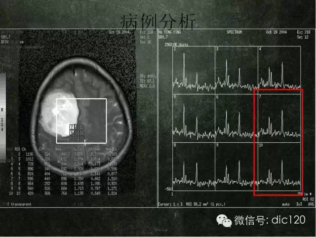 【PPT】脑磁共振波谱MRS