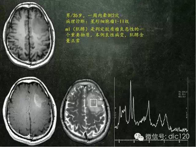 【PPT】脑磁共振波谱MRS