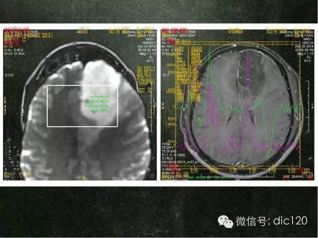 【PPT】脑磁共振波谱MRS