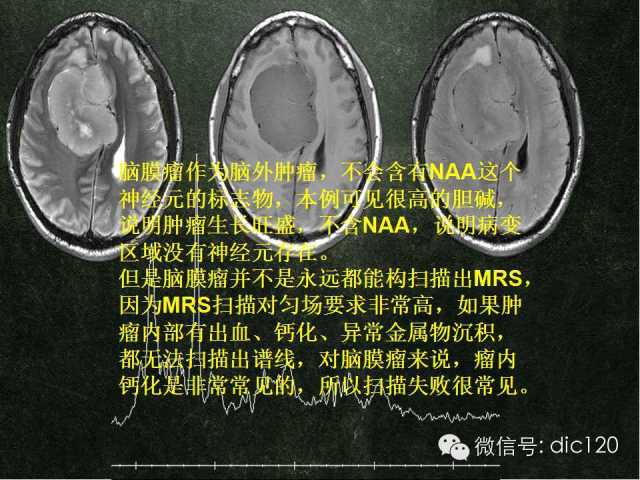 【PPT】脑磁共振波谱MRS