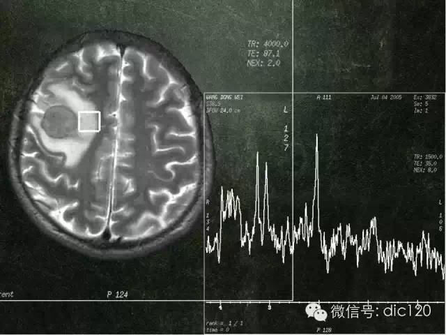 【PPT】脑磁共振波谱MRS