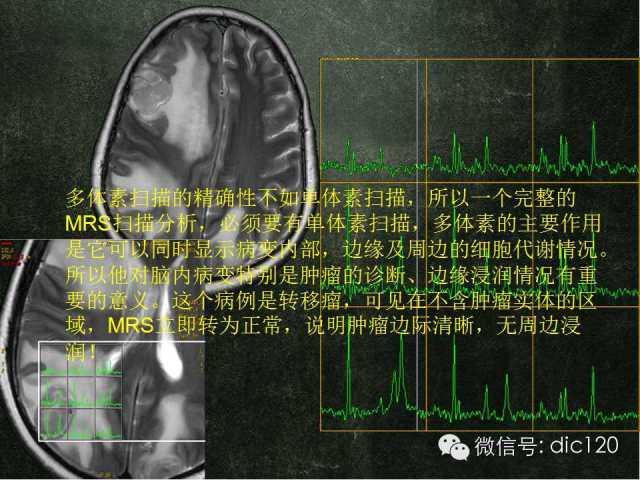 【PPT】脑磁共振波谱MRS