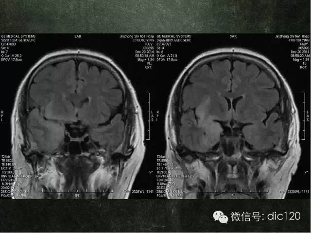 【PPT】脑磁共振波谱MRS