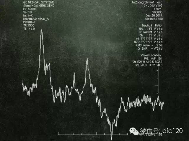 【PPT】脑磁共振波谱MRS