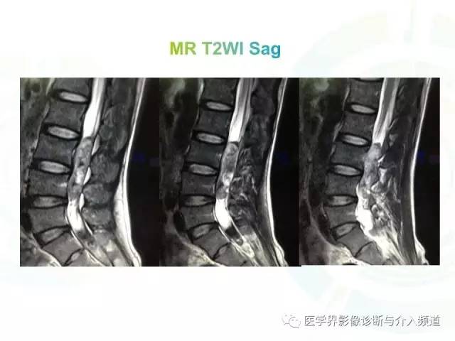 【病例】腰椎椎管内室管膜瘤1例MR