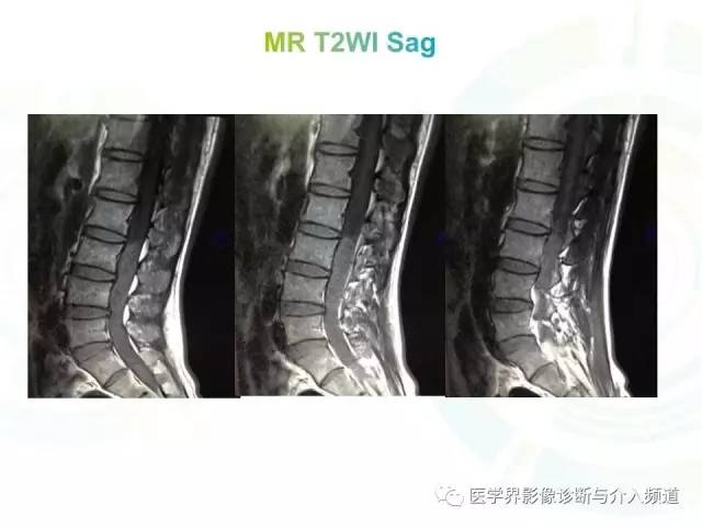 【病例】腰椎椎管内室管膜瘤1例MR
