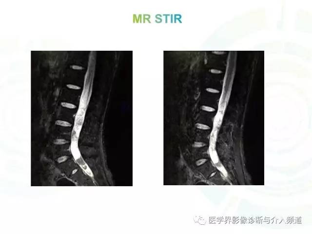【病例】腰椎椎管内室管膜瘤1例MR