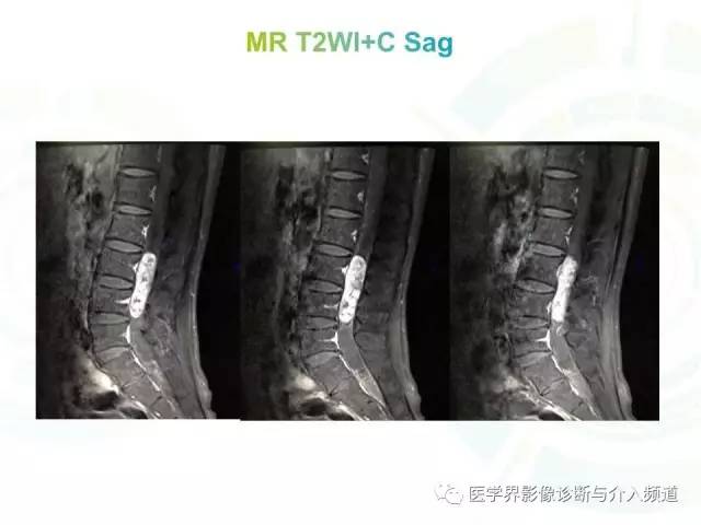 【病例】腰椎椎管内室管膜瘤1例MR
