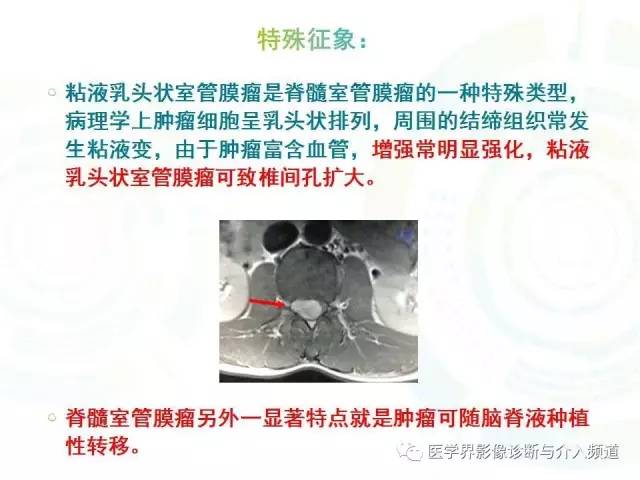 【病例】腰椎椎管内室管膜瘤1例MR