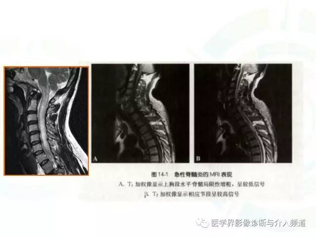 【病例】腰椎椎管内室管膜瘤1例MR