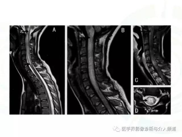 【病例】腰椎椎管内室管膜瘤1例MR