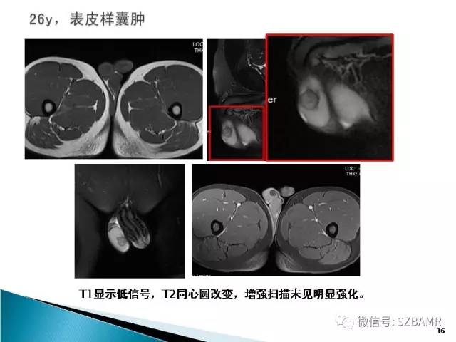 【PPT】睾丸肿瘤病变MR诊断