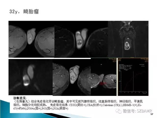 【PPT】睾丸肿瘤病变MR诊断