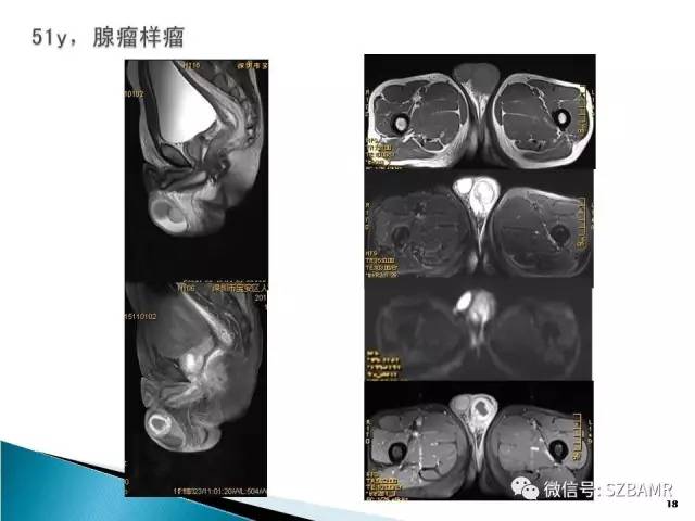 【PPT】睾丸肿瘤病变MR诊断