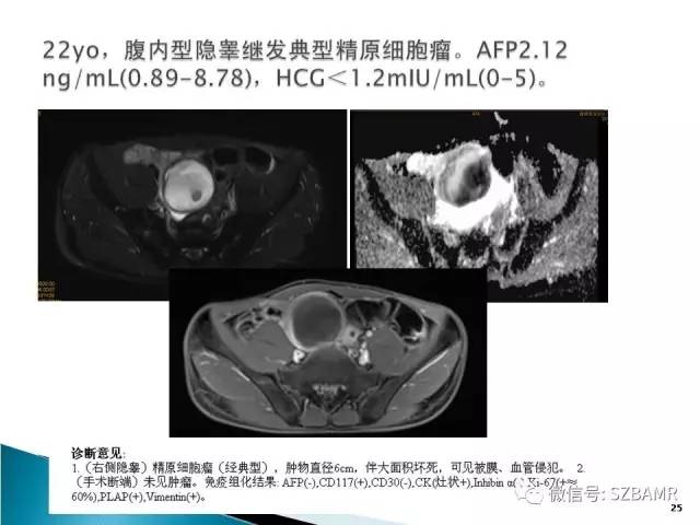 【PPT】睾丸肿瘤病变MR诊断