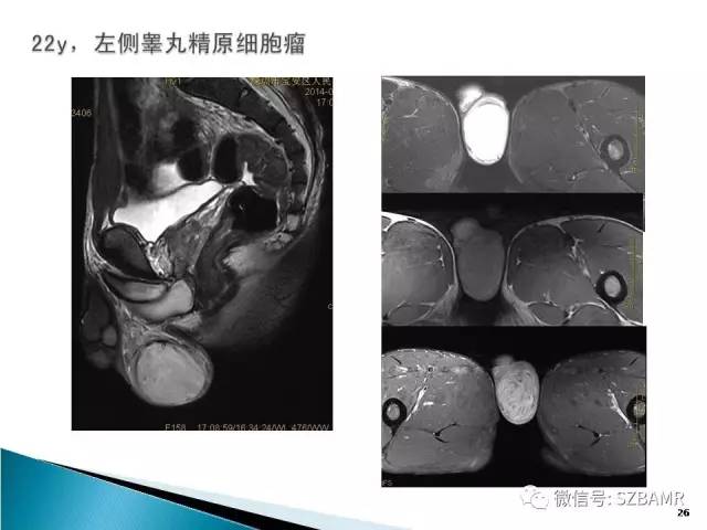 【PPT】睾丸肿瘤病变MR诊断