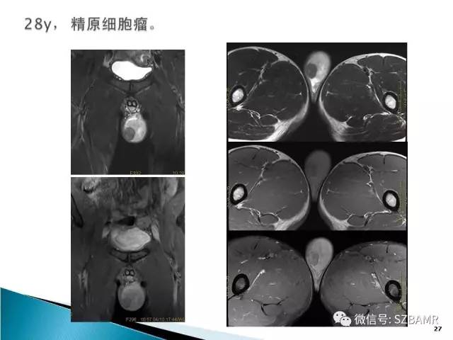 【PPT】睾丸肿瘤病变MR诊断