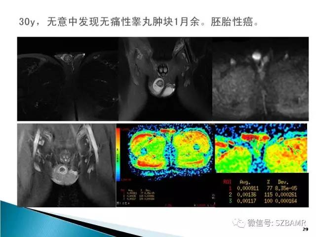 【PPT】睾丸肿瘤病变MR诊断